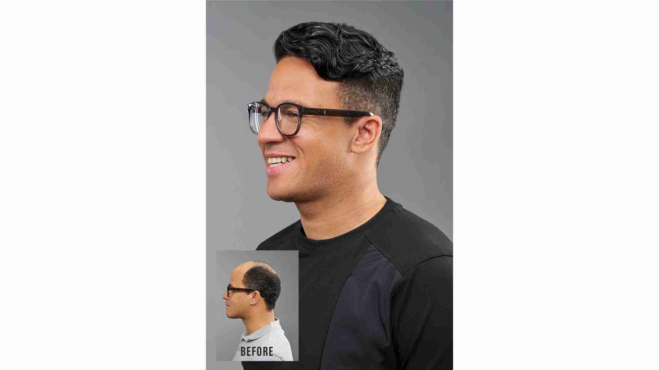 5 Popular Men’s Hair Restoration Techniques Explained