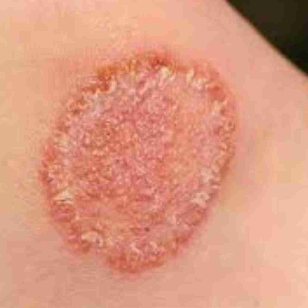 How Effective Are Molnupiravir Capsules in Fighting Viral