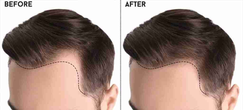 Hair Transplant in Pakistan: Regaining Confidence with Follicular Restoration
