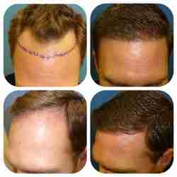 hair transplant in Islamabad