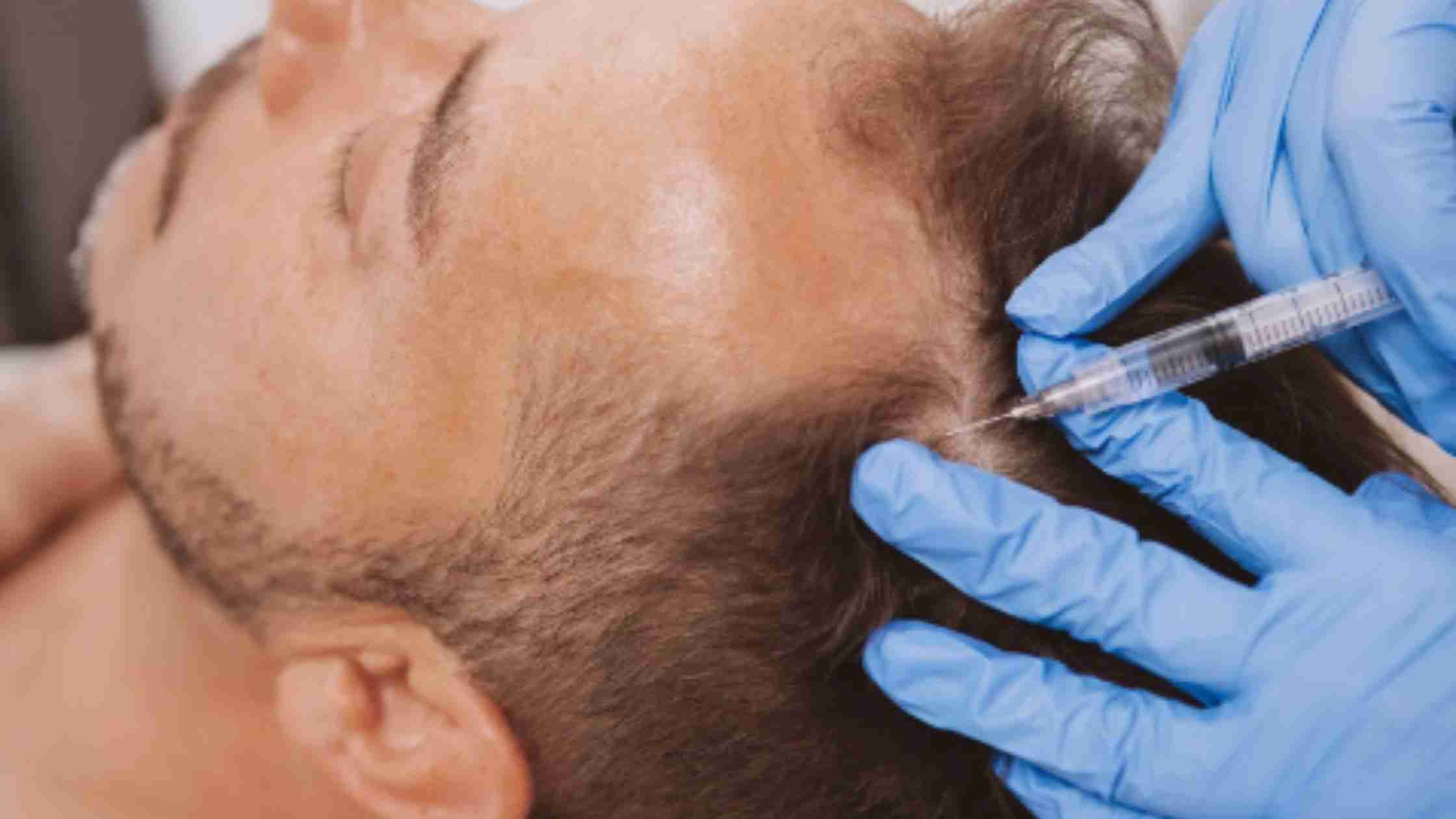 What Can You Expect from PRP Treatment for Your Face? Before and After Insights!