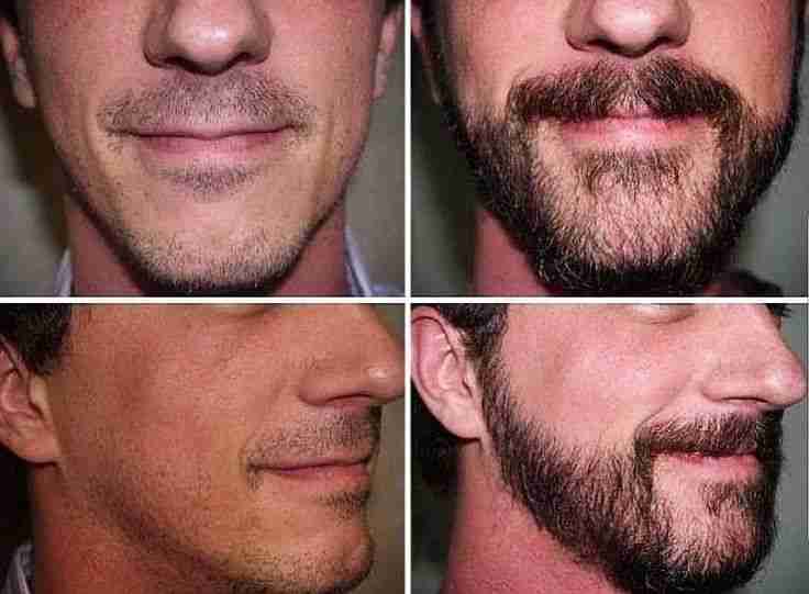 Understanding the Process of Beard Hair Transplantation in Dubai