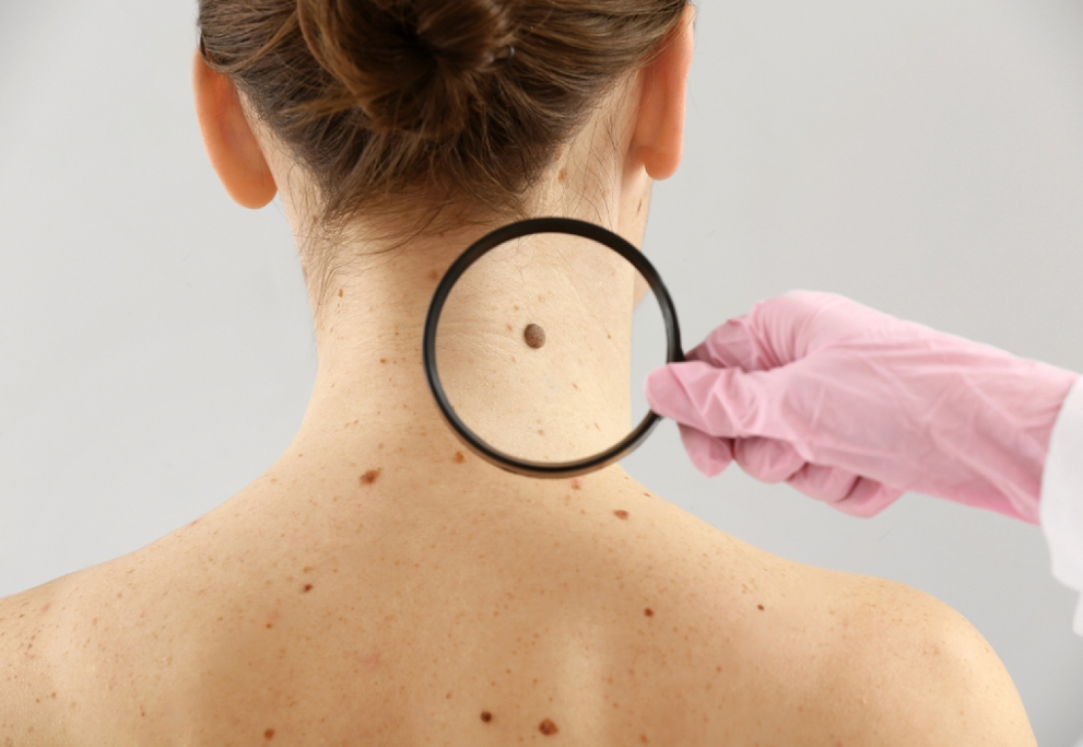 Mole Assessment for Aging Skin: What You Need to Know