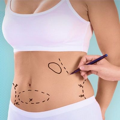 Best Liposuction in Dubai