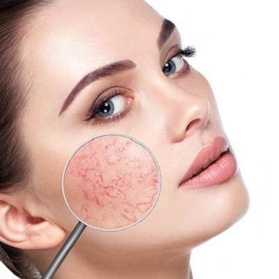 Step-by-Step Guide to Treating Rosacea in Dubai
