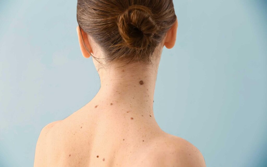 New Skin Tag Removal for Athletes: Tips for Dubai Residents