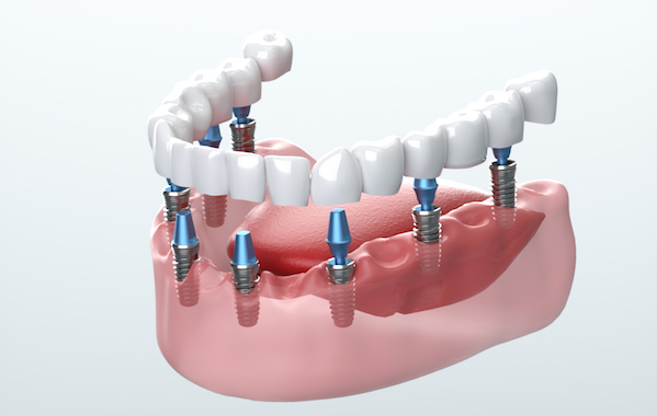 Regain Your Confidence with Dental Implants