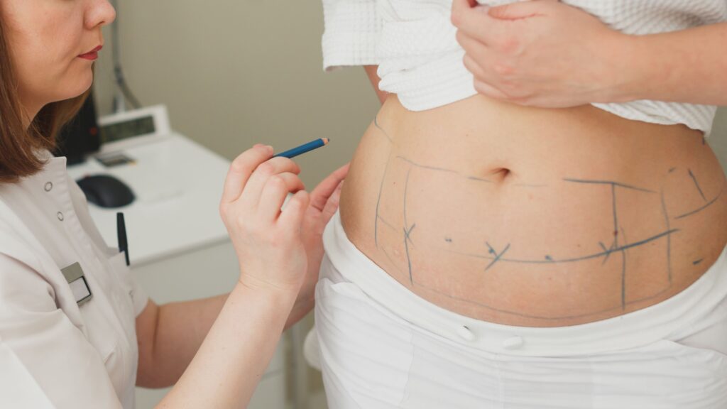 Conventional vs. Modern Body Contouring Techniques