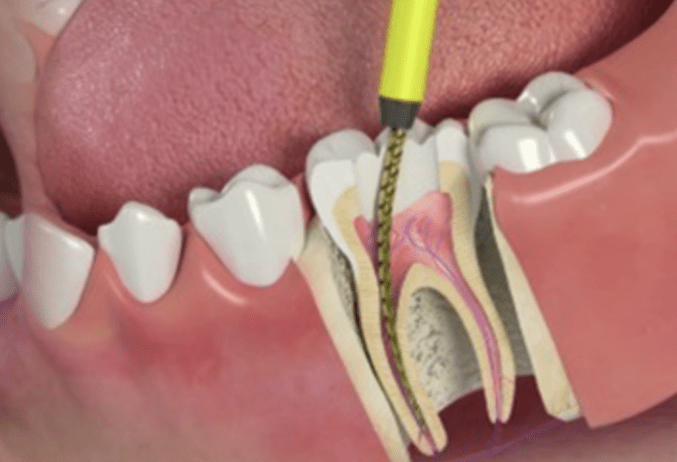 Why Tooth Abscess Treatment is Essential for Oral Health