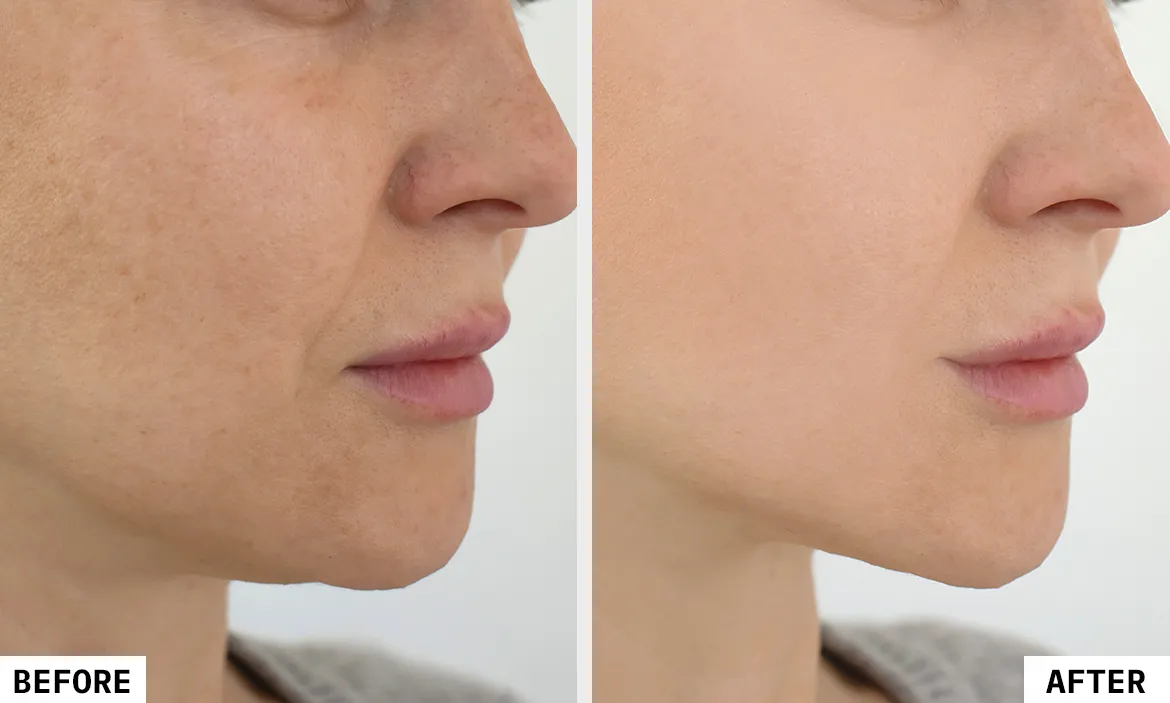 The Versatile Applications of HIFU Treatment