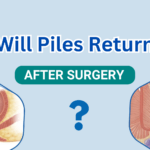 Debunking the Myth: Will Piles Return After Surgery?