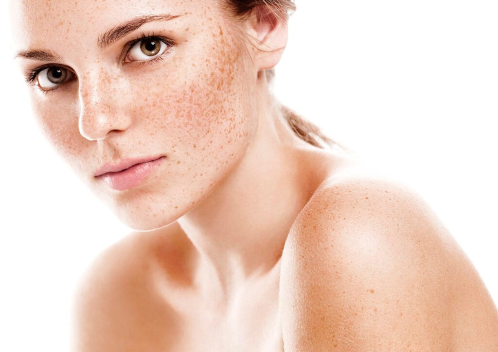 Chemical Peels for Melasma Treatment in Islamabad: What You
