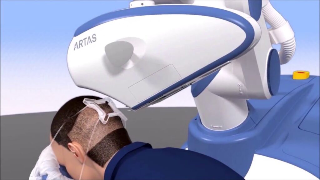 Achieve Fuller, Natural Hair with Robotic Hair Transplant in