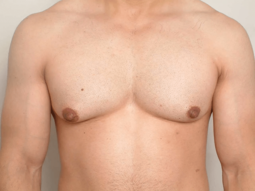 Is Gynecomastia More Prevalent in Obese Individuals?