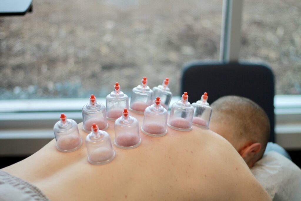 Is Hijama Cupping Therapy a Key to Enhancing Mobility?
