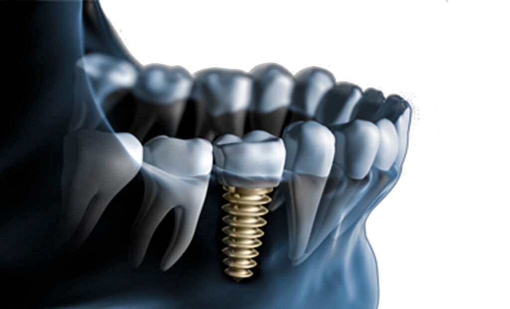 Fast-Track Dental Implant Procedures in Islamabad: What Yot