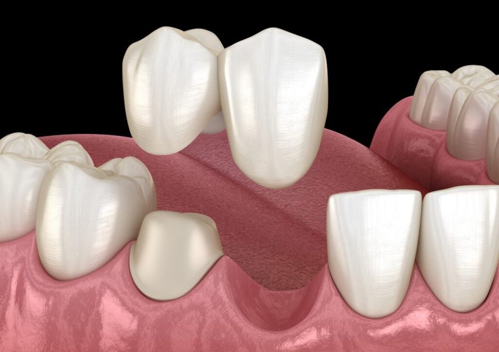 Dental Crown & Bridges for Partial Tooth Loss A Non-Invasive