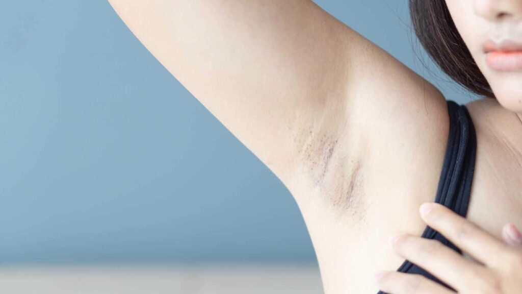 Armpit Hyperpigmentation After Chemical Peeling