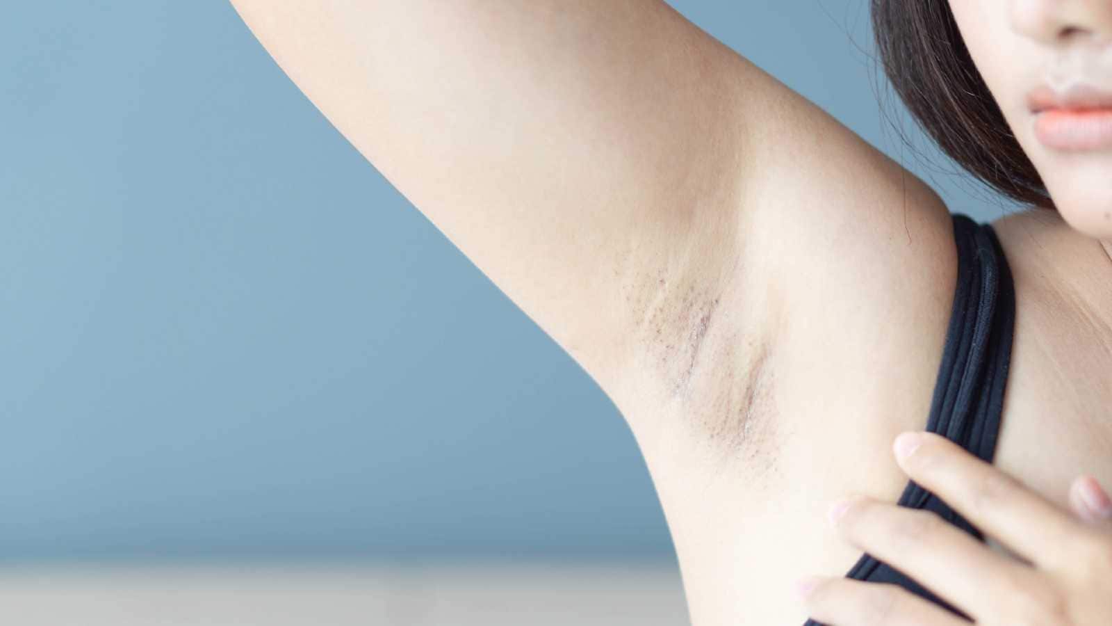 Armpit Hyperpigmentation After Chemical Peeling
