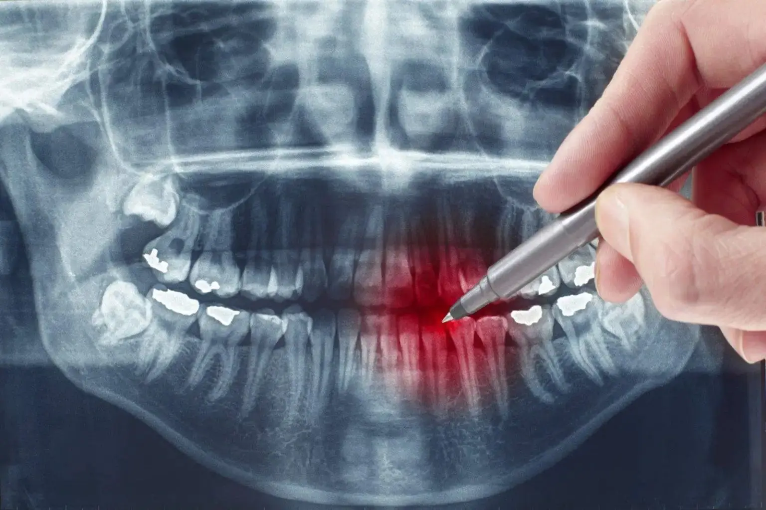 Dental X Rays In Marietta, GA