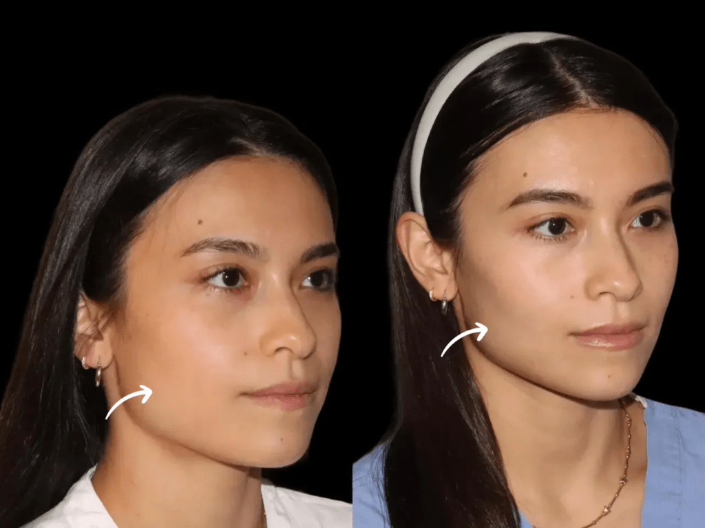 How Sculptra Fillers in Dubai Can Revitalize Dull Tired Skin