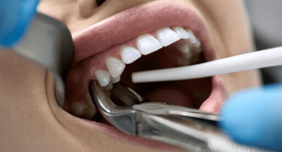 Wisdom Tooth Extraction: Do’s and Don’ts After Surgery