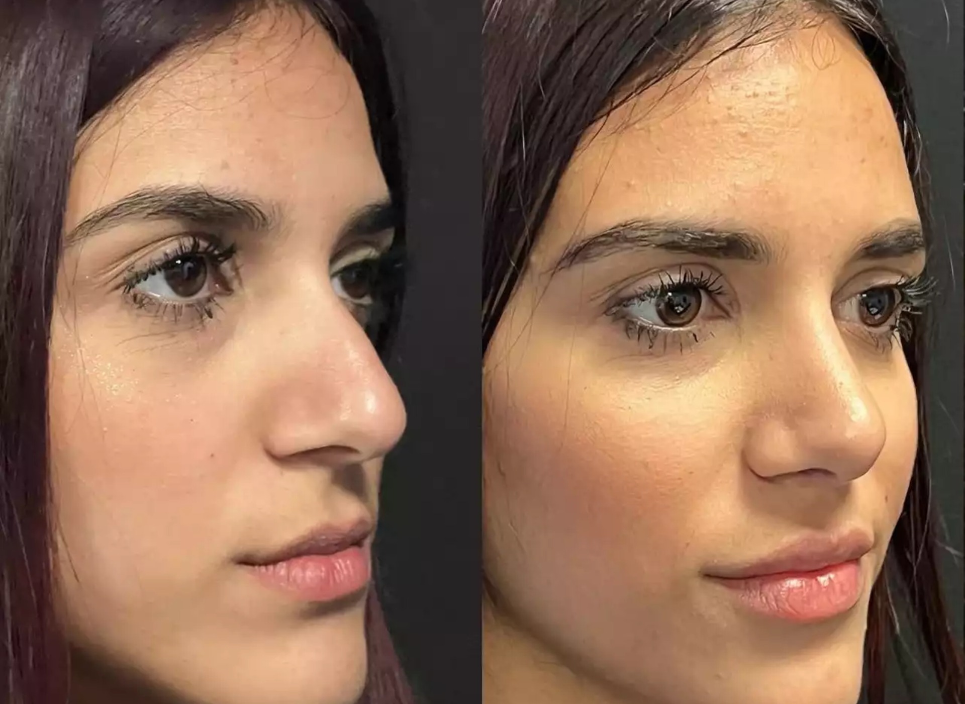 Best Septoplasty Surgeons in Dubai: Advanced Procedures