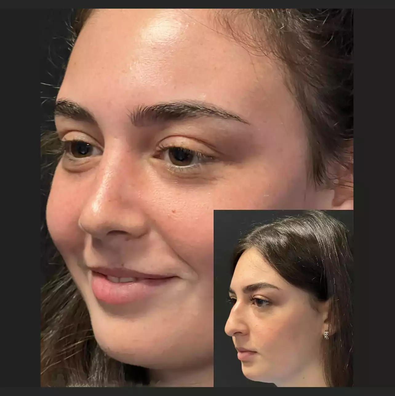 Expert-Recommended: Best Doctors in Dubai for Rhinoplasty