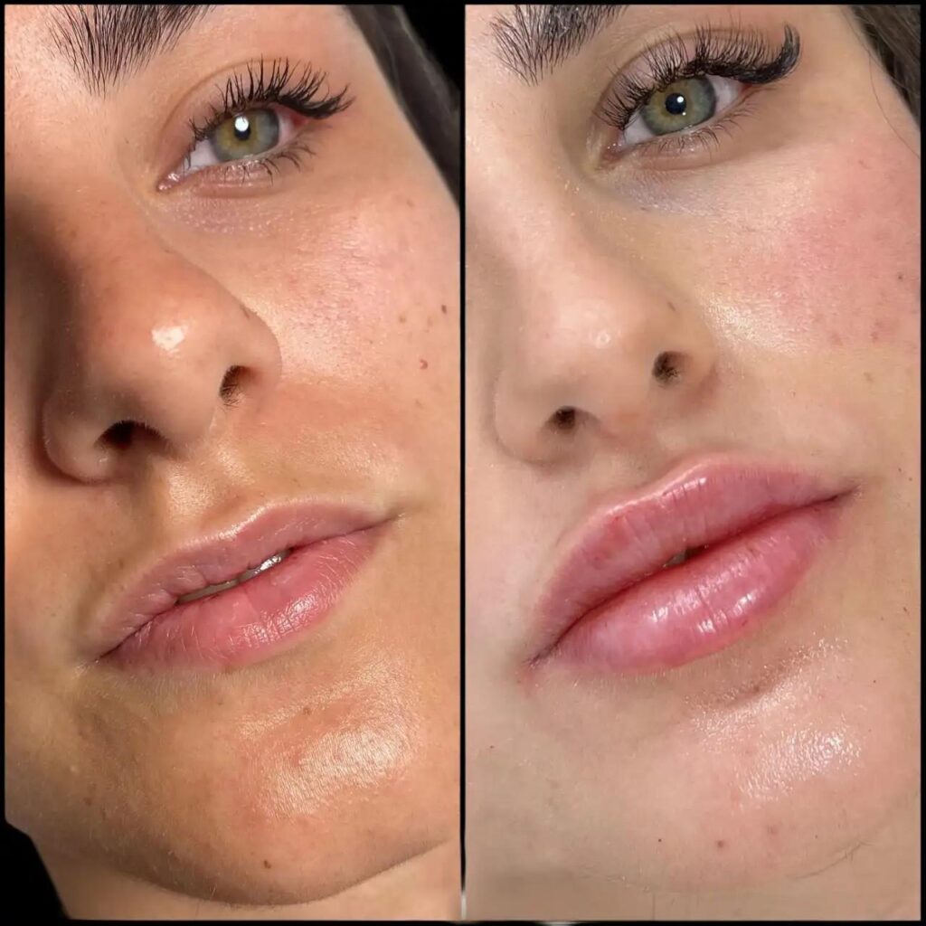 What Makes Dermal fillers in dubai Different from Fillers in Other Countries?
