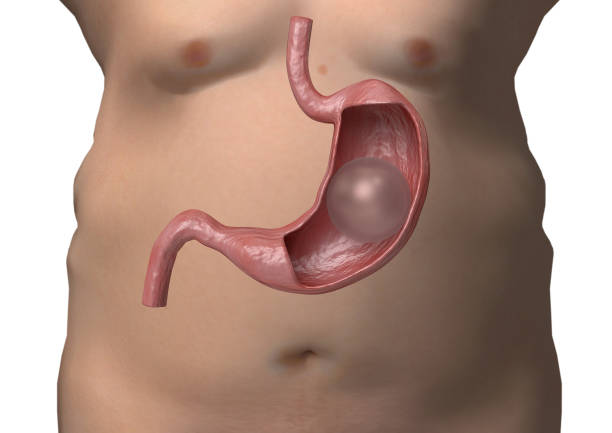 How Do I Prepare for Gastric Balloon Placement in Dubai