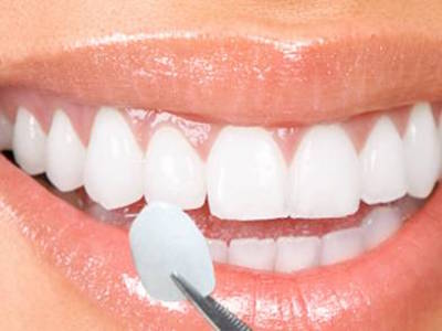 How Do Veneers Affect Oral Hygiene Practices in Dubai