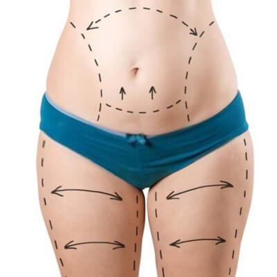 How Does Age Affect Tummy Tuck Results in Dubai