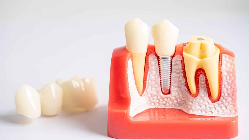 How Does Dental Implant Technology Improve My Results