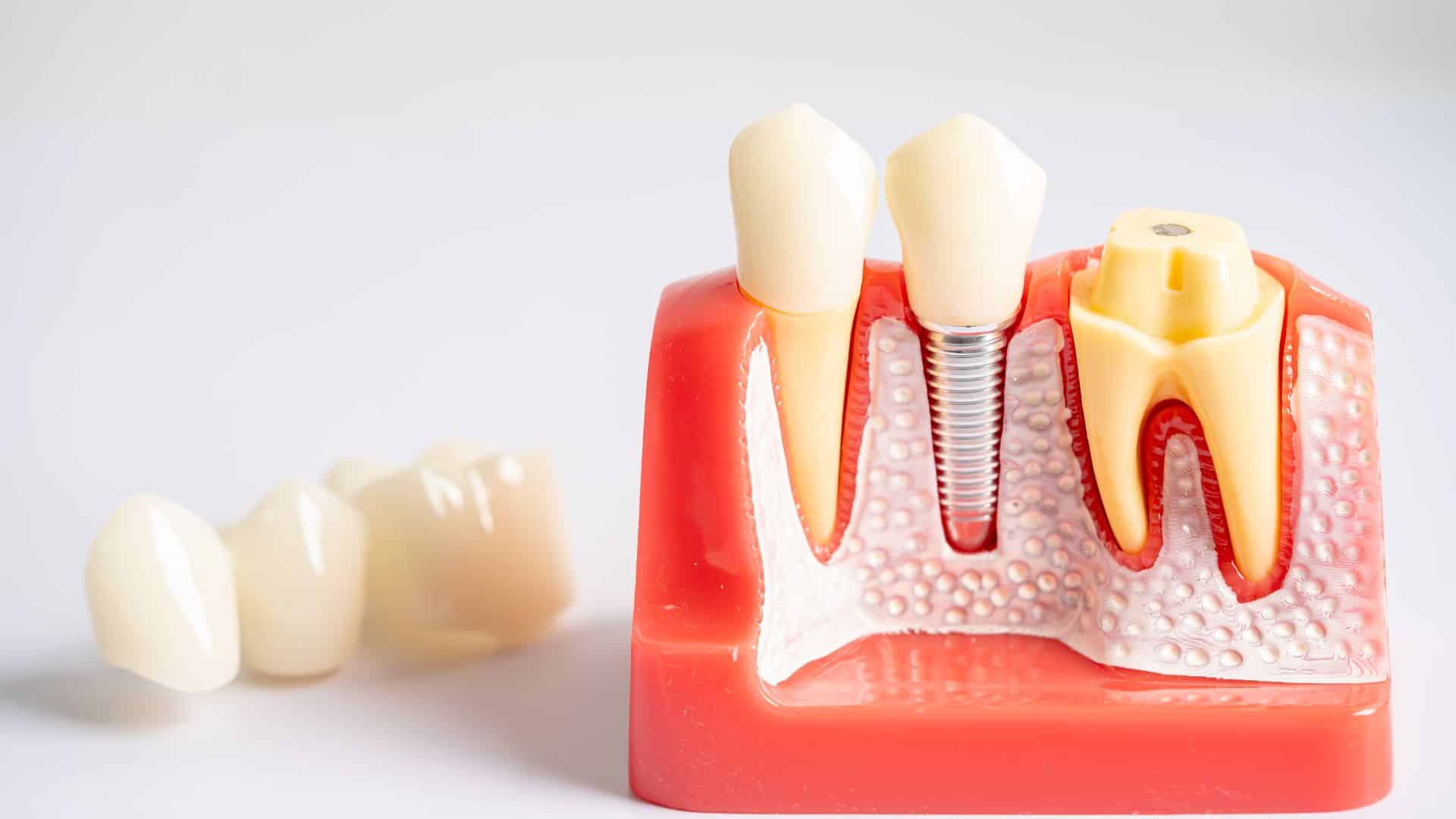 How Does Dental Implant Technology Improve My Results