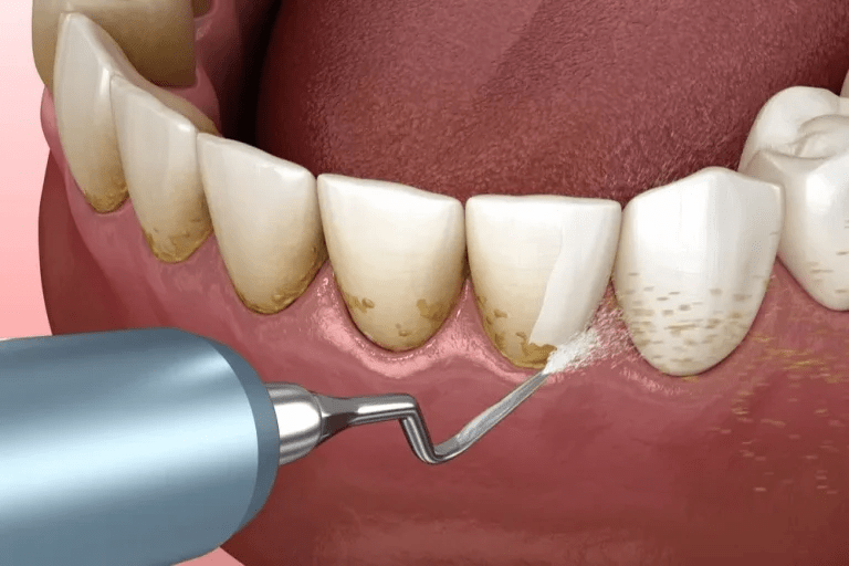 How Does Teeth Cleaning in Dubai Contribute to Overall Healt