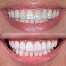 Is It Safe to Travel Right After Getting E-Max Veneers in Du