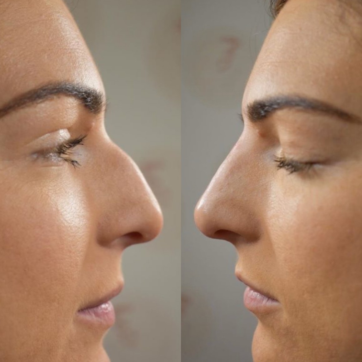 Is There a Best Time of Year to Get a Nose Job in Dubai
