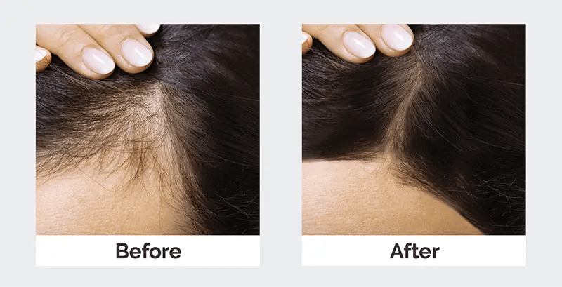 What Are the Latest Advances in Hair Loss Treatment in Dubai