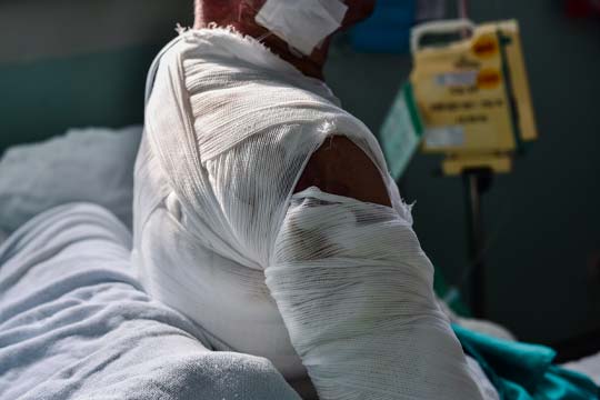 How a Costa Mesa Burn Injury Lawyer Can Maximize Your Compen