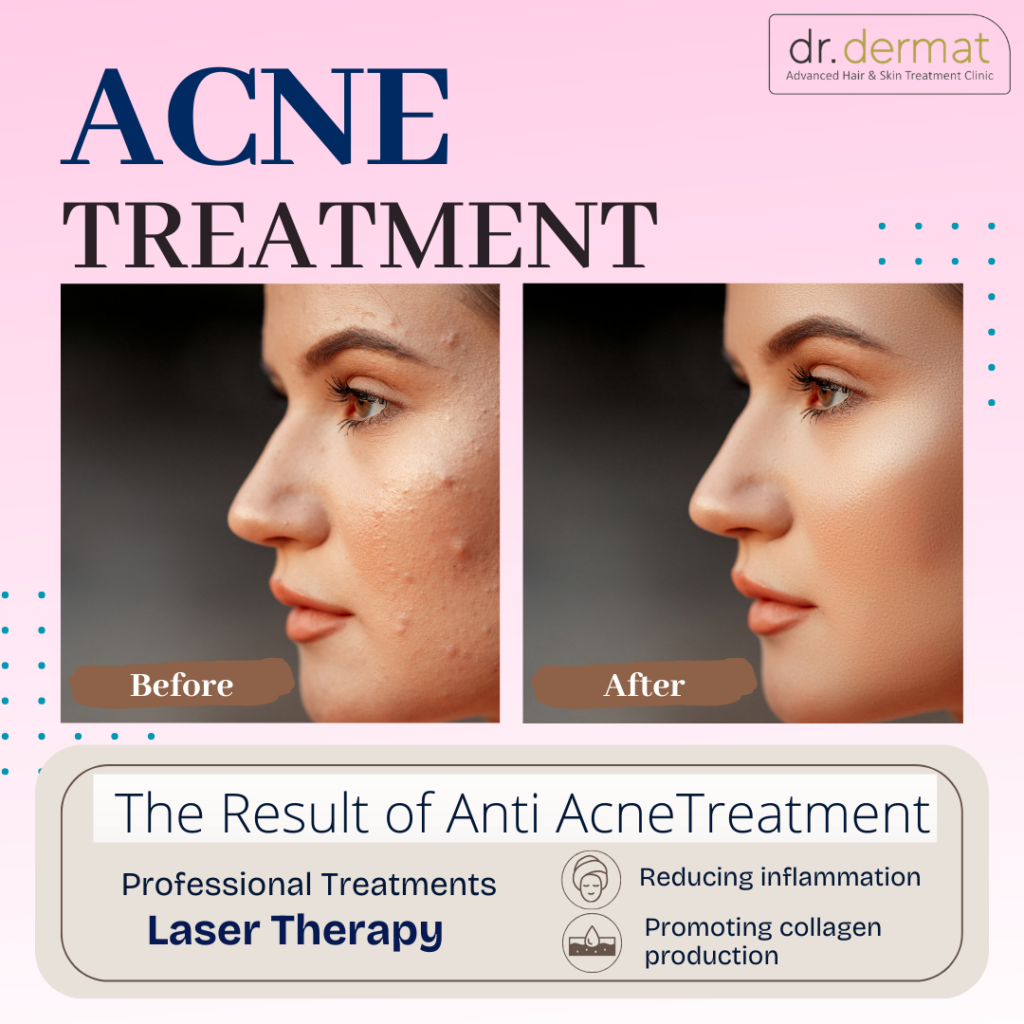 Salicylic Acid vs Benzoyl Peroxide: Which is Better for Acne