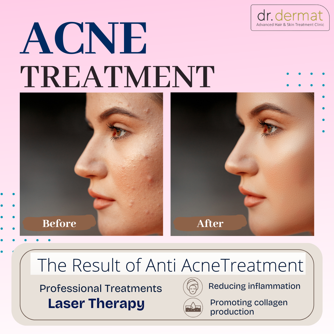 Salicylic Acid vs Benzoyl Peroxide: Which is Better for Acne