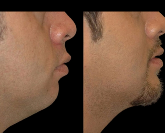 Best Double chin removal Surgeons in dubai: How to Achieve a Sculpted Jawline