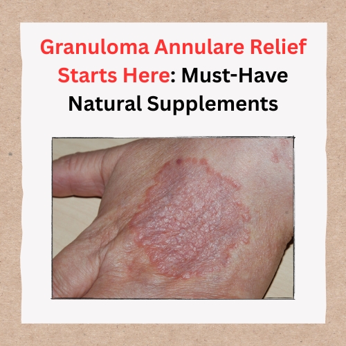 Granuloma Annulare Relief Starts Here: Must-Have Natural Sup