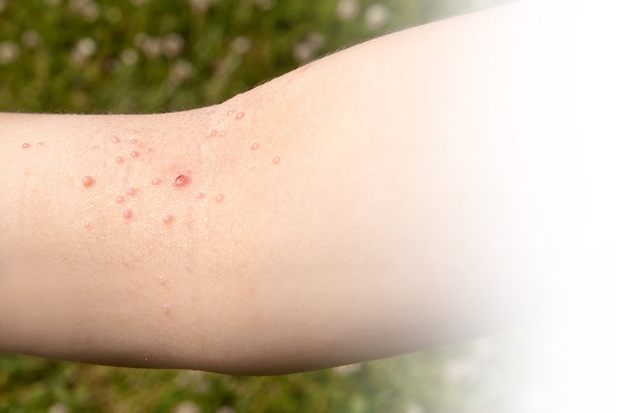 A Safe and Easy Way Salicylic Acid Helps Remove Warts