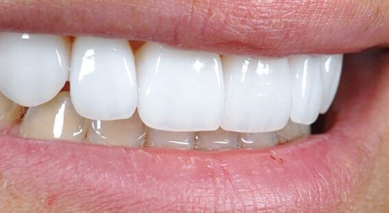 Are E-Max Veneers More Expensive Than Traditional Veneers in