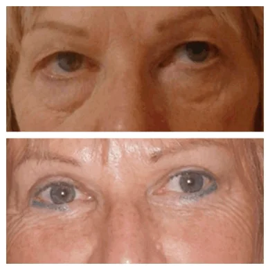 Can Eye Bag Removal Be Reversed? The Best Eye bag removal Surgeon in dubai Explains