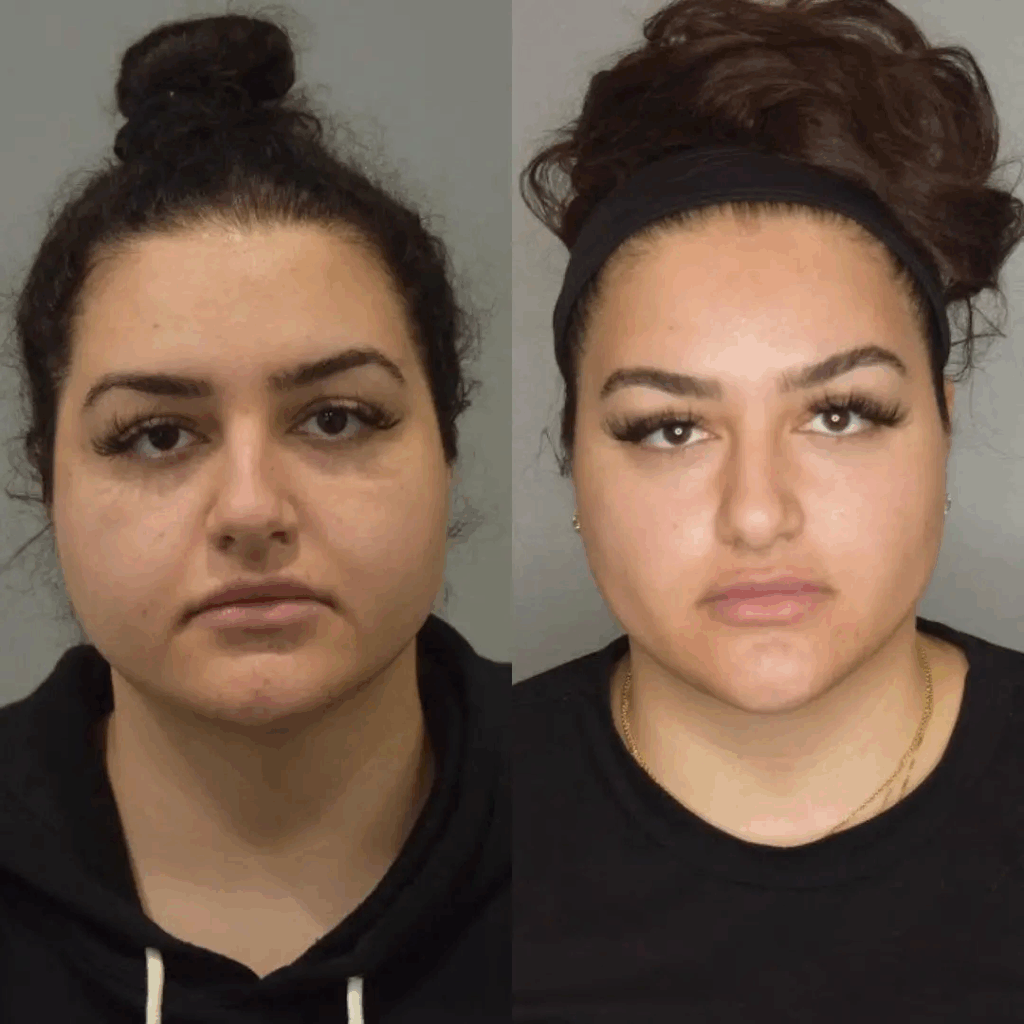 Best Buccal fat removal Surgeons in dubai: What Happens if You Regain Weight?