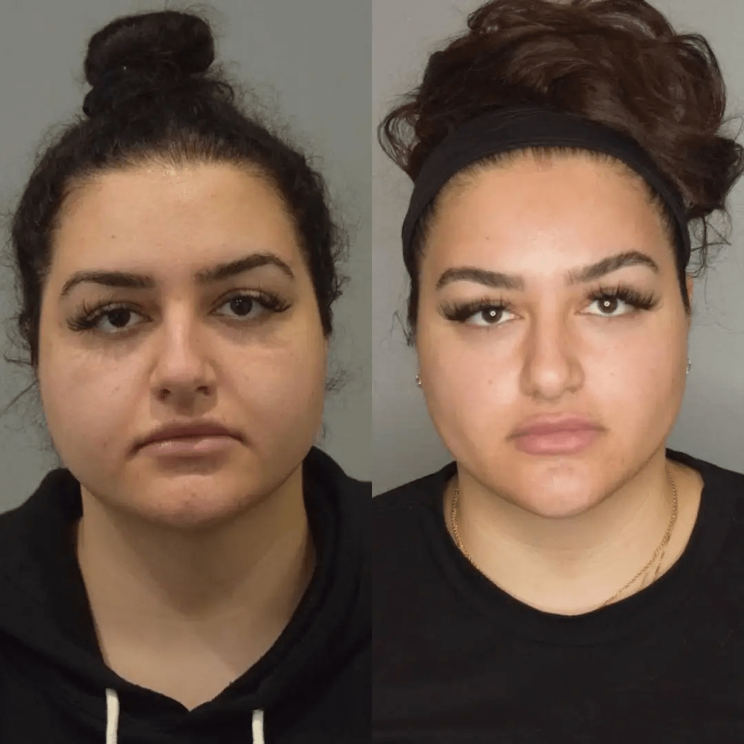 Best Buccal fat removal Surgeons in dubai: What Happens if You Regain Weight?