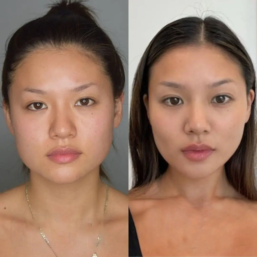 Does Buccal fat removal in Dubai Affect Facial Expressions?