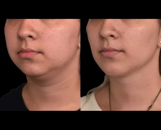 What Makes the Best Double chin removal Surgeon in dubai Stand Out from the Rest?